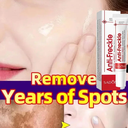 Whitening Freckle Cream Remove Dark Spots Anti Freckle Face Creams Niacinamide Fade Pigmentation Melasma Brighten Skin Care 20g