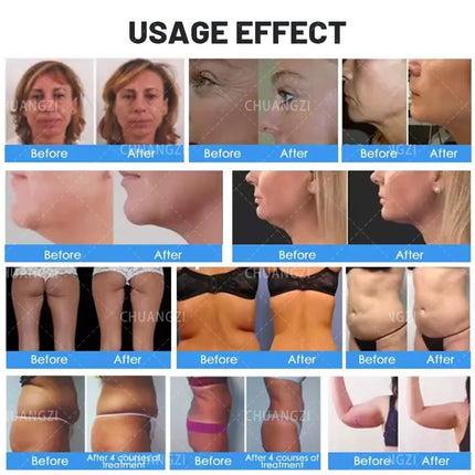 Monopolar RF 2-in-1 Facial Rejuvenation and 360 Body Contouring Machine for Cellulite Reduction and Skin Tightening