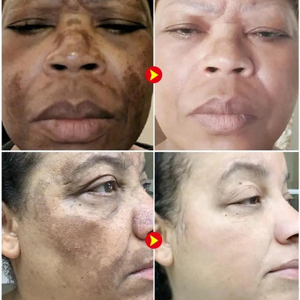 Powerful Spot-removing Whiten Cream Brighten Skin Fast Eliminates Melanin Pigmentation Melasma Dark Spots Moisturize Beauty Gel