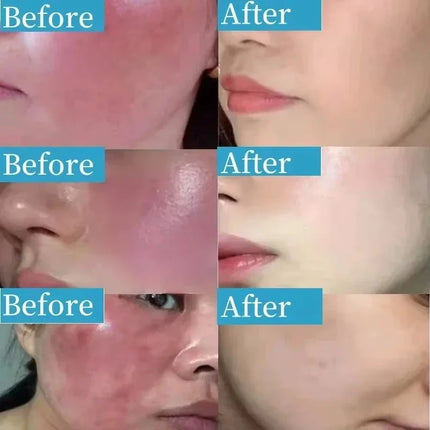 Facial Redness Repair Cream Improve Sensitive Skin Dryness Moisturizer Hydrating Sooth Lotion Removal Rosacea Korean Cosmetics