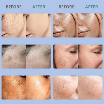 Niacinamide Whitening Spot Removal Cream Dark Spot Corrector Face Cream Melasma Freckle Sun Spot Remover Brighten Anti-Aging 30g