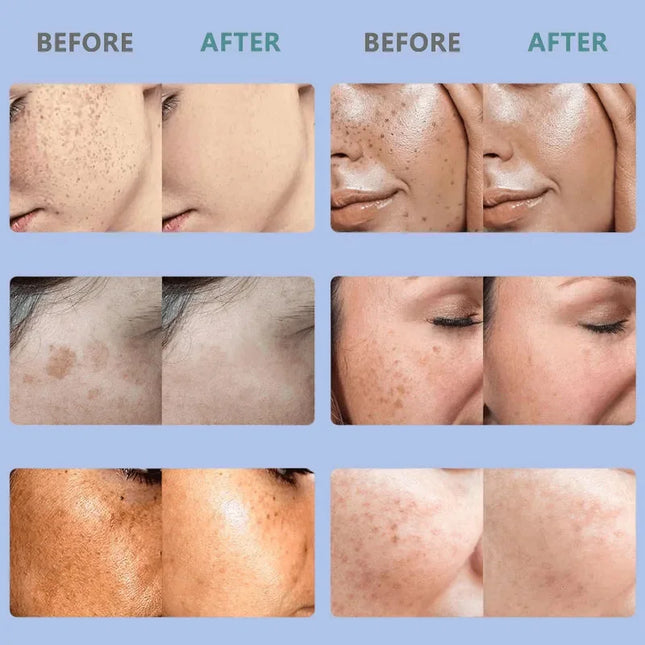 Niacinamide Whitening Spot Removal Cream Dark Spot Corrector Face Cream Melasma Freckle Sun Spot Remover Brighten Anti-Aging 30g