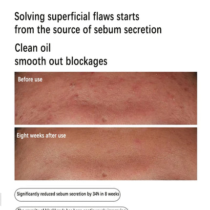 Niacinamide 10% + Zinc 1% Serum 30ml Control Oil Remove Acne and Brighten Oily Skin Gentle Exfoliating Closed-mouth Essence
