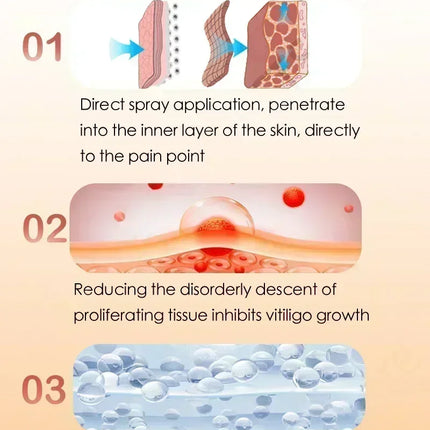 [New] Vitiligo Cream Vitiligo Remover Tinea Versicolor Body Lotion Helps Get Rid of Sweat Spot Vitiligo, Skin Vitiligo Clear
