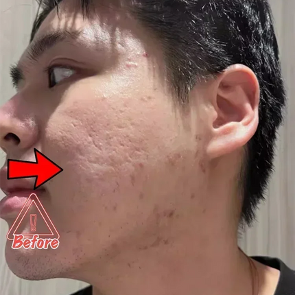Anti-acne mark pothole Repair Men's Hole Repair Cream Fade to remove acne mark scar fade fill regeneration gel