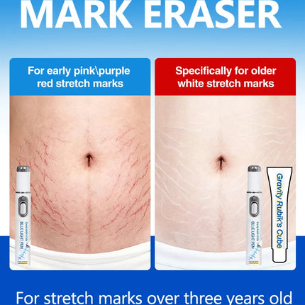Striae Laser Device Eliminate Body Stretch Marks Products