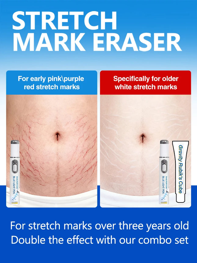 Striae Laser Device Eliminate Body Stretch Marks Products