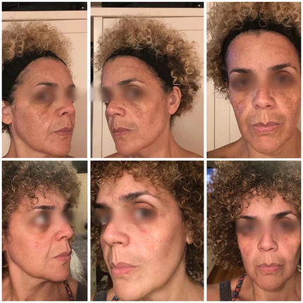 Whitening Freckle Cream Remove Dark Spots Anti Freckle Face Creams Niacinamide Fade Pigmentation Melasma Brighten Skin Care 20g