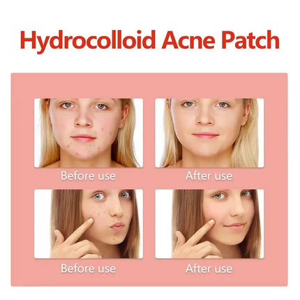 144pcs Invisible Removal Pimple Anti-Acne Hydrocolloid Patches Spots Marks Concealer Repair Sticker Waterproof Beauty-health