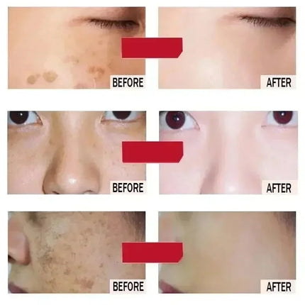 Niacinamide Whitening Spot Removal Cream Dark Spot Corrector Face Cream Melasma Freckle Sun Spot Remover Brighten Anti-Aging 30g