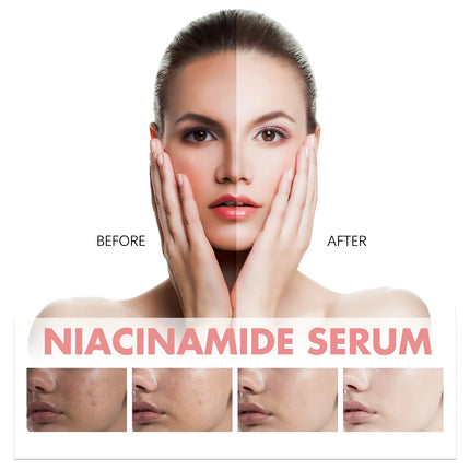 Peach 70% Niacinamide Facial Serum Fade Melanin Moisturzing Shrink Pores Smooth Brightening Skin Care Dark Spot Remover Serum