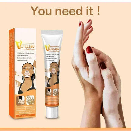 [New] Vitiligo Cream Vitiligo Remover Tinea Versicolor Body Lotion Helps Get Rid of Sweat Spot Vitiligo, Skin Vitiligo Clear
