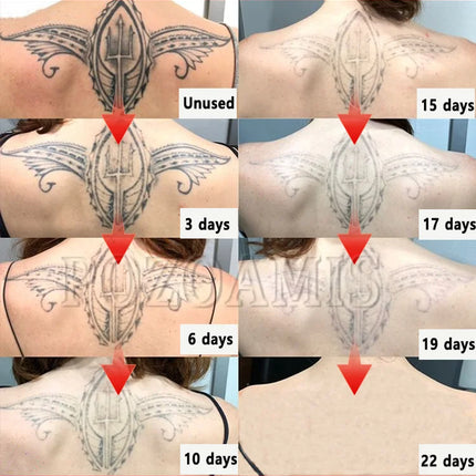 Remove old tattoos with a single click.