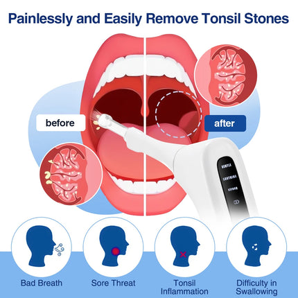 Visible Electric Tonsil Stone Remover Tool Visible Tonsil Stone Removal Kit 3 Suction Modes Tonsil Stone Removal Oral Care