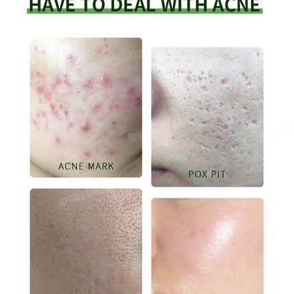 Anti-Acne Cream Effectively Removes Skin Nodules Pustules Cysts Papules Blackheads Men And Women Acne Skin Care Essence Cream
