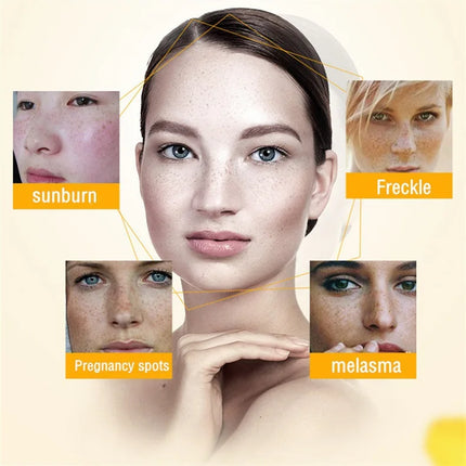 Effective Whitening Freckles Cream Remove Melasma Dark Spots Fade Melanin Pigmentation Moisturizing Brighten Skin Care Products