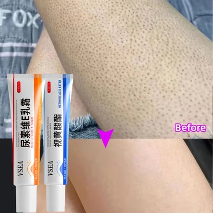 Body Whitening Cream Keratosis Pilaris Treatment Bumpy Rough Chicken Follicle Skin Repair Strawberry Legs Removal Dry Skin Care