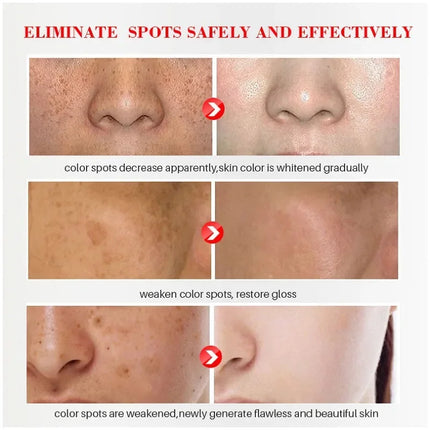 Effective Whitening Freckles Cream Remove Melasma Dark Spots Fade Melanin Pigmentation Moisturizing Brighten Skin Care Products