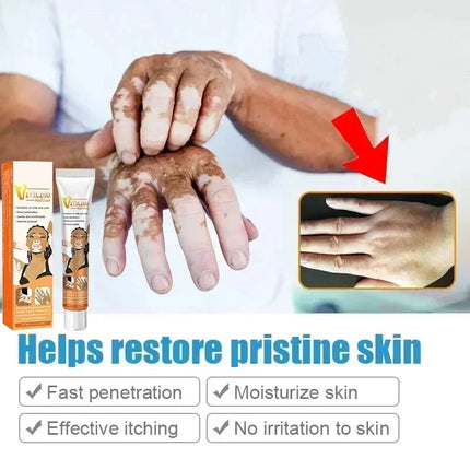 [New] Vitiligo Cream Vitiligo Remover Tinea Versicolor Body Lotion Helps Get Rid of Sweat Spot Vitiligo, Skin Vitiligo Clear