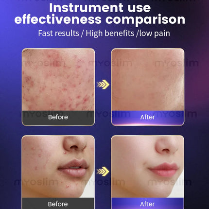 Anti-Aging Facial Beauty Machine – Salon Professional Lifting Tightening Wrinkle & Fine Line Reduction Device