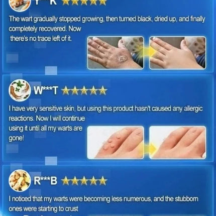 Blue Light Wart Remover Tool Painless Wart Removal Improve Skin Condition Better Life