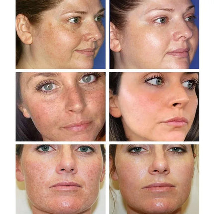 Effective Whitening Freckles Cream Remove Melasma Dark Spots Fade Melanin Pigmentation Moisturizing Brighten Skin Care Products