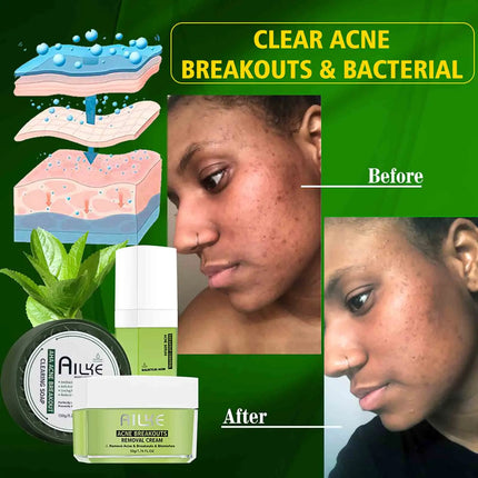 AILKE Acne Removal Face Care Set, Effectively Anti Acne-Prone Skin, Pimples, Control Breakouts, Unclog Pores, For Women and Men