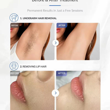 2026 New 4000W 4-Wave Laser Hair Removal - 808/755/940/1064nm Diode Cooling System Painless Permanent Hair Remover for All Skin