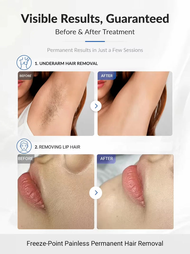 2026 New 4000W 4-Wave Laser Hair Removal - 808/755/940/1064nm Diode Cooling System Painless Permanent Hair Remover for All Skin