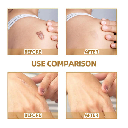 Skin concealing patch-waterproof cover for scars, tattoos, acne marks, birthmarks-natural looking, breathable, reusable