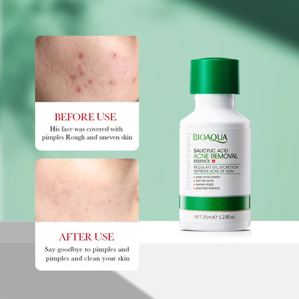 35ml BIOAOUA Salicylic Acid Anti-Acne Removal Essence Regulate Oil Secretion Improve Acne Of Skin Smooth Skin Blackhead Removal