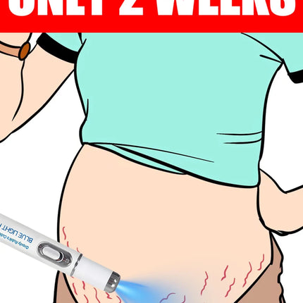 Striae Laser Device Eliminate Body Stretch Marks Products