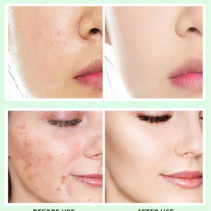 Anti-Acne Cream Effectively Removes Skin Nodules Pustules Cysts Papules Blackheads Men And Women Acne Skin Care Essence Cream