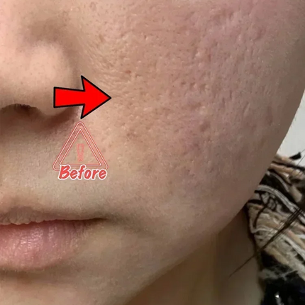 Anti-acne mark pothole Repair Men's Hole Repair Cream Fade to remove acne mark scar fade fill regeneration gel