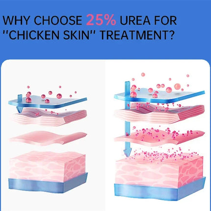 Body Whitening Cream Keratosis Pilaris Treatment Bumpy Rough Chicken Follicle Skin Repair Strawberry Legs Removal Dry Skin Care