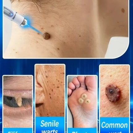 Blue Light Wart Remover Tool Painless Wart Removal Improve Skin Condition Better Life