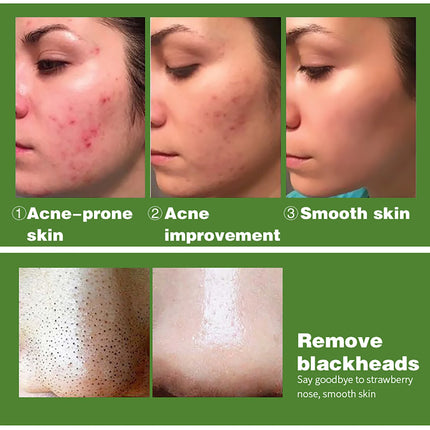 AILKE Acne Removal Face Care Set, Effectively Anti Acne-Prone Skin, Pimples, Control Breakouts, Unclog Pores, For Women and Men