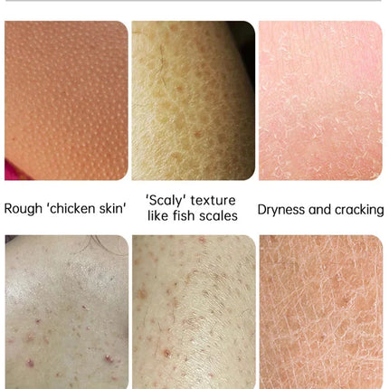 Body Whitening Cream Keratosis Pilaris Treatment Bumpy Rough Chicken Follicle Skin Repair Strawberry Legs Removal Dry Skin Care