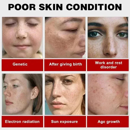 Niacinamide Whitening Spot Removal Cream Dark Spot Corrector Face Cream Melasma Freckle Sun Spot Remover Brighten Anti-Aging 30g