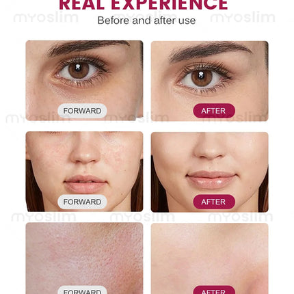 7D HIFU Beauty Machine with Multi Depth Treatment Heads for Facial Firming and Body Contouring