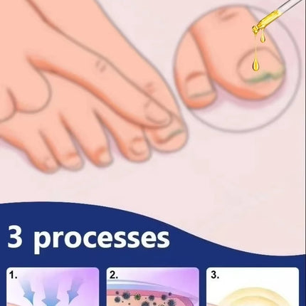 18 Quickly eliminate fungus and restore healthy nails