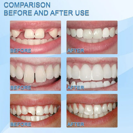 Temporary Tooth Repair Beads | Food Grade Dental Filling Material for Missing Broken Teeth, Denture Adhesive Solid Glue