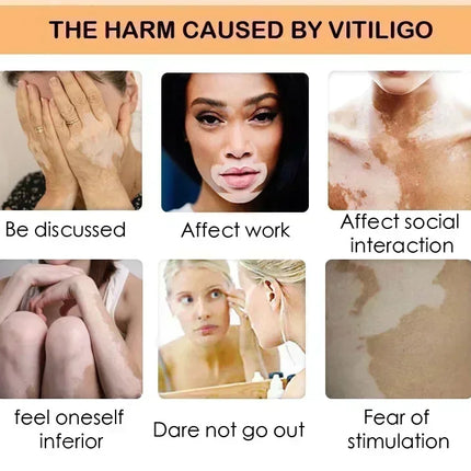 [New] Vitiligo Cream Vitiligo Remover Tinea Versicolor Body Lotion Helps Get Rid of Sweat Spot Vitiligo, Skin Vitiligo Clear