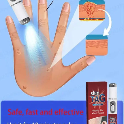 Best-Selling Blue Light Pen: Effective for Body Wart Removal & Wart Care