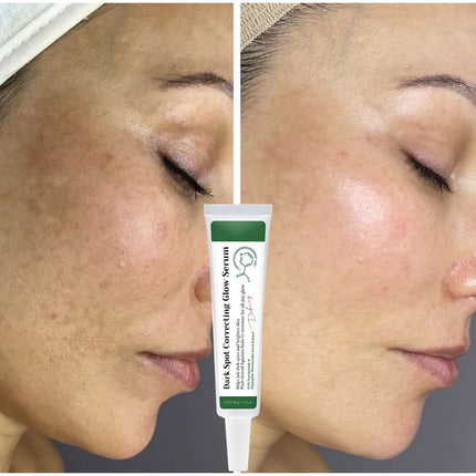 Dark Spot Correcting Glow Serum,Dullness,Acne,And Melanin Remover,Niacinamide Facial Skin Moisturizing Brightening Skincare