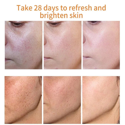 Effective Whitening Freckles Cream Remove Melasma Dark Spots Fade Melanin Pigmentation Moisturizing Brighten Skin Care Products