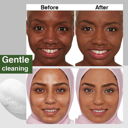 AILKE Acne Removal Face Care Set, Effectively Anti Acne-Prone Skin, Pimples, Control Breakouts, Unclog Pores, For Women and Men