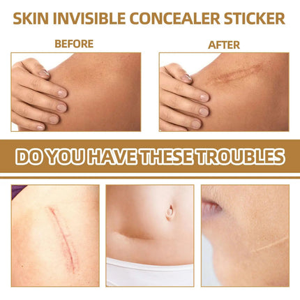 Skin concealing patch-waterproof cover for scars, tattoos, acne marks, birthmarks-natural looking, breathable, reusable
