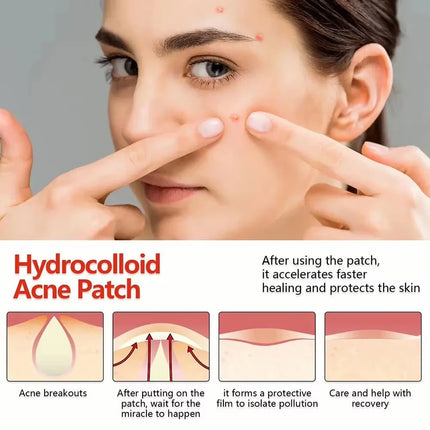 144pcs Invisible Removal Pimple Anti-Acne Hydrocolloid Patches Spots Marks Concealer Repair Sticker Waterproof Beauty-health