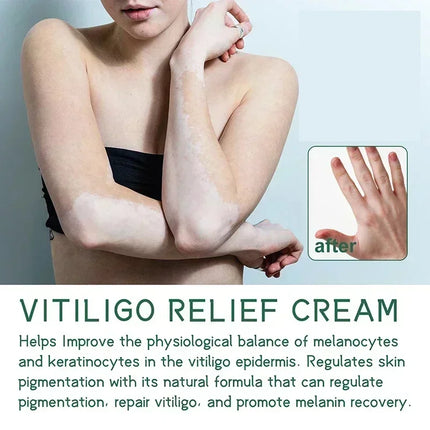 [New] Vitiligo Cream Vitiligo Remover Tinea Versicolor Body Lotion Helps Get Rid of Sweat Spot Vitiligo, Skin Vitiligo Clear